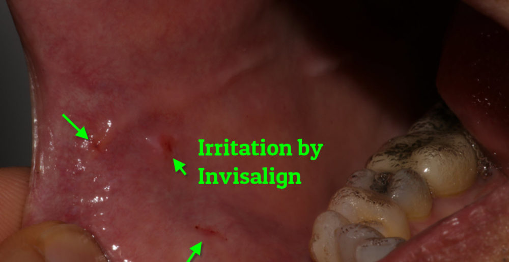 Invisalign and Irritation of Cheek