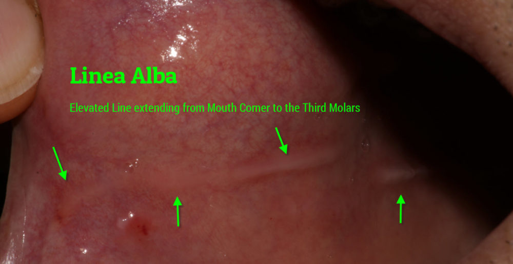 Raised Line on the the Cheek