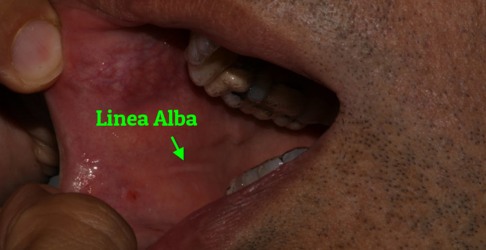 Linea Alba Line on the Cheek