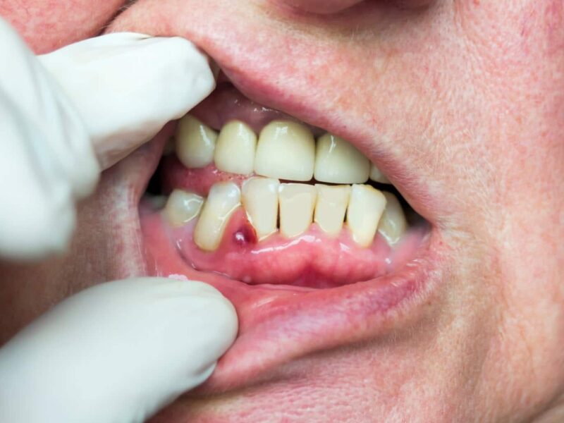 Dental abscess in Brisbane dental abscess