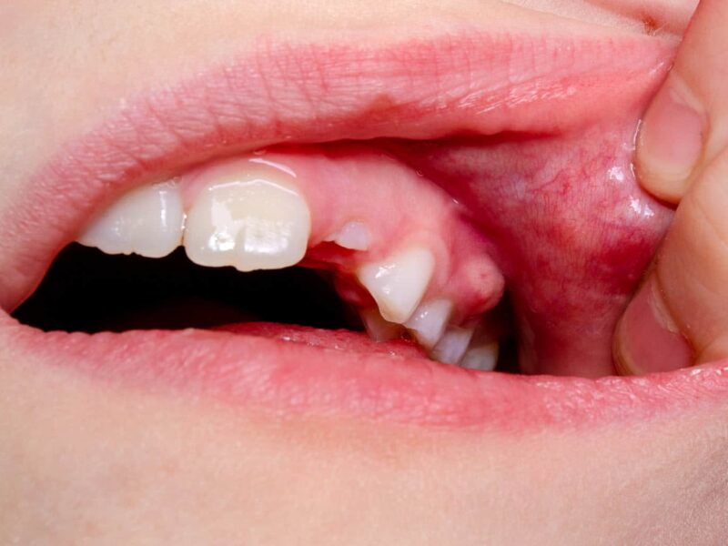 dental abscess Dental Abscess