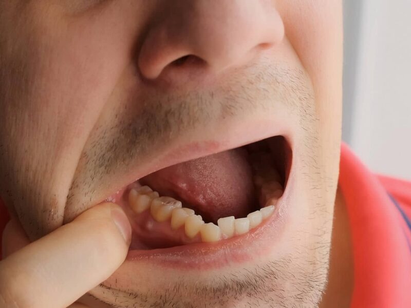 periodontal abscess dental abscess