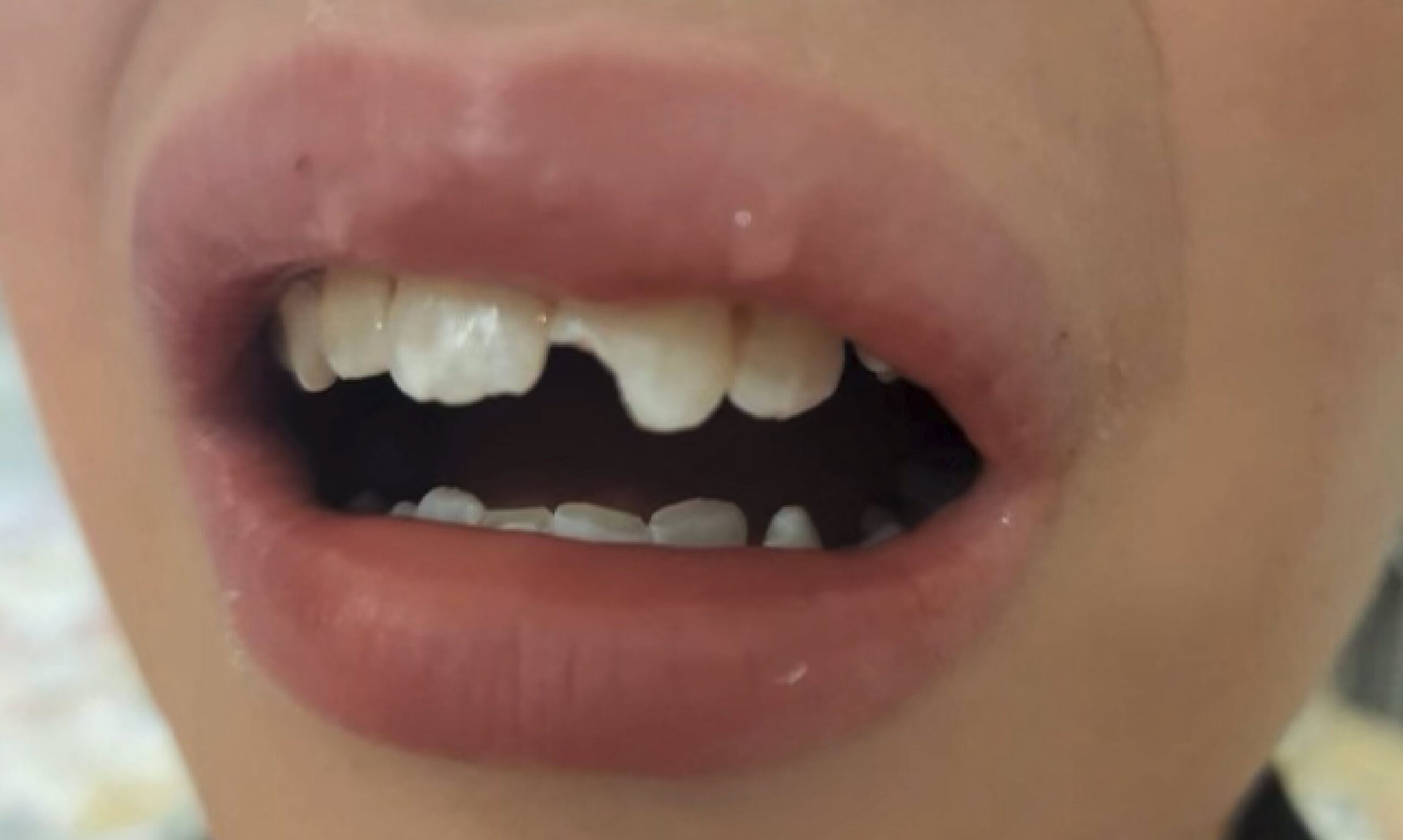 Tooth injury restoration in Brisbane