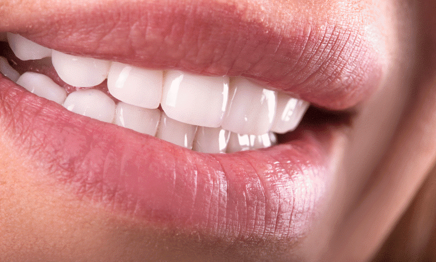 Perfect your smile with porcelain dental veneers