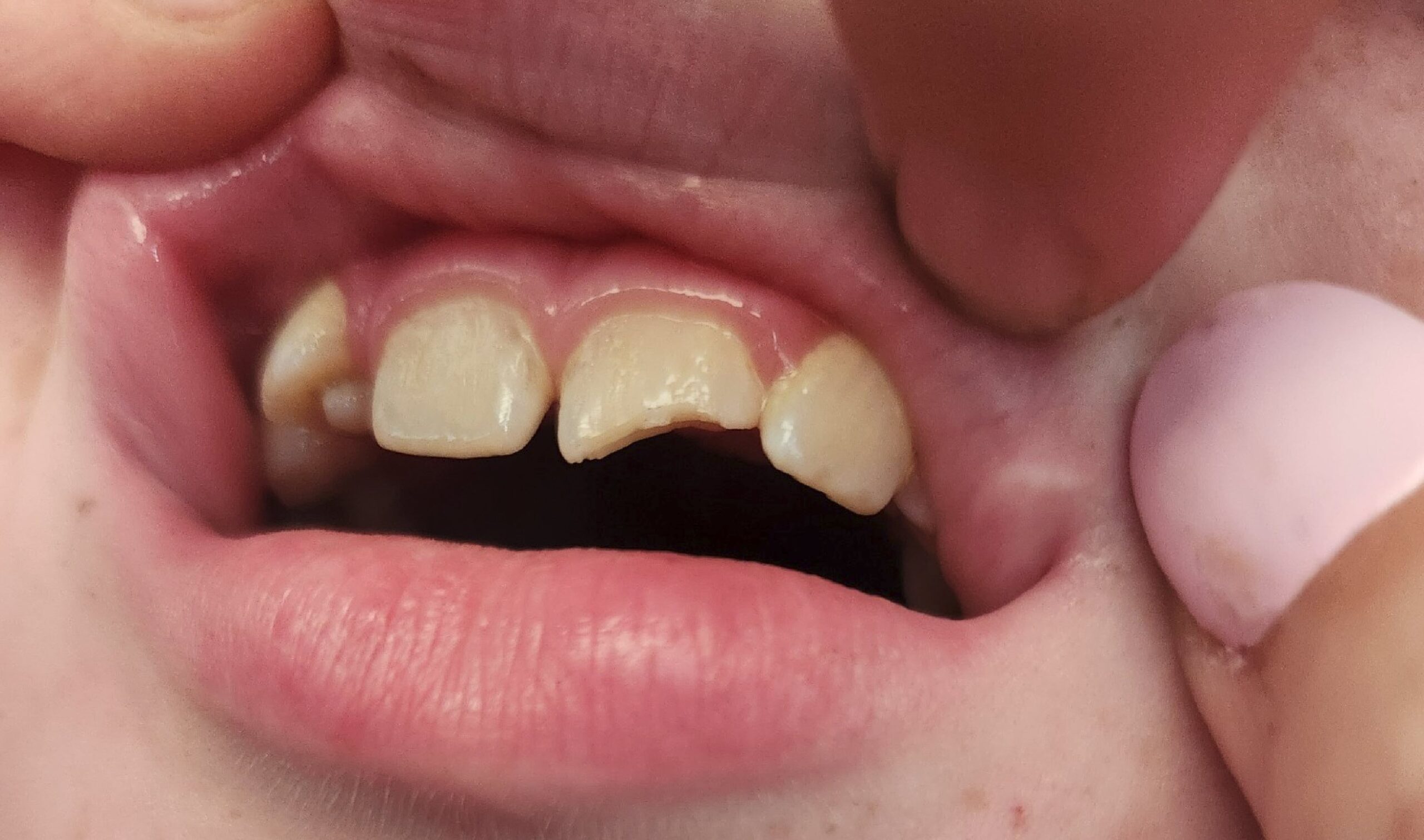 Chipped tooth repair