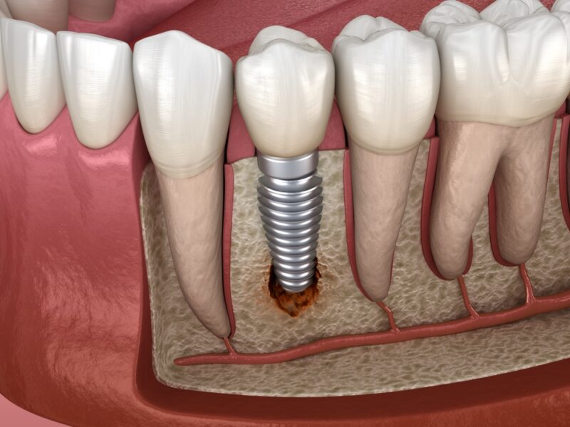 dental implant loose dental implant