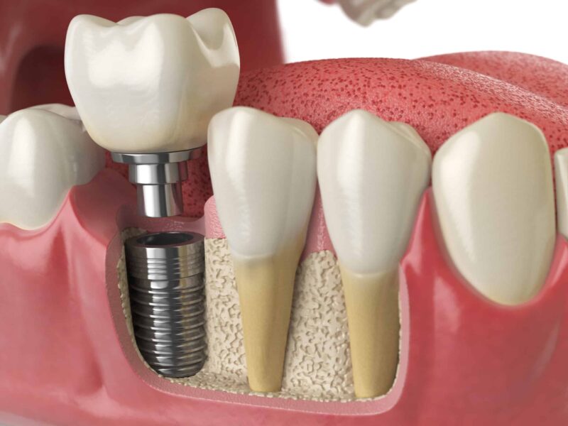 dental implant brisbane loose dental implant