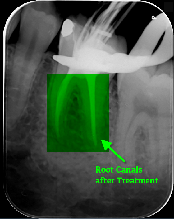 Saving the natural tooth