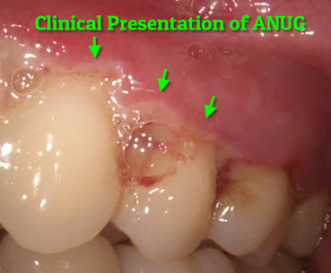 Necrotizing Ulcerative Gingivitis Anug