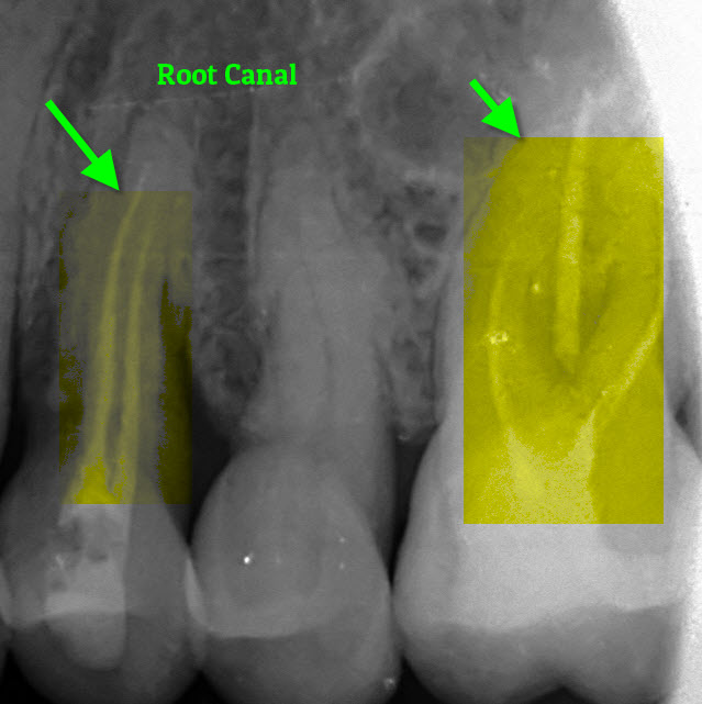 Root Canal X-Ray