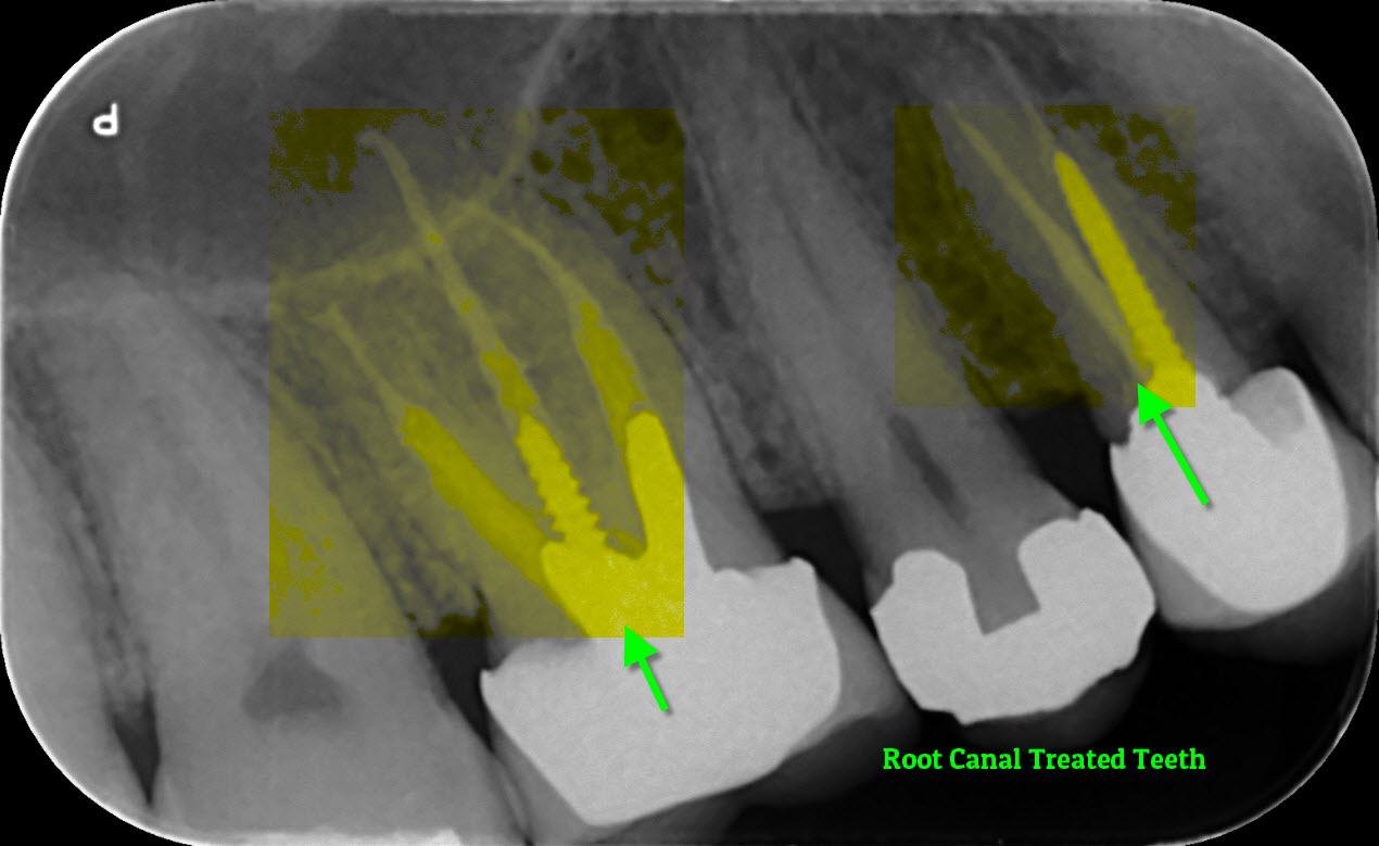 X-ray of RCT teeth