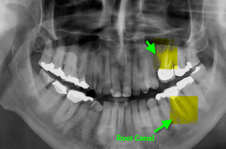 Root Canal treatment