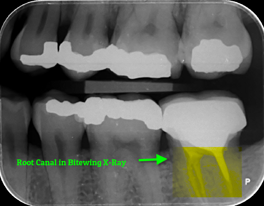 Root Canal Bite wing