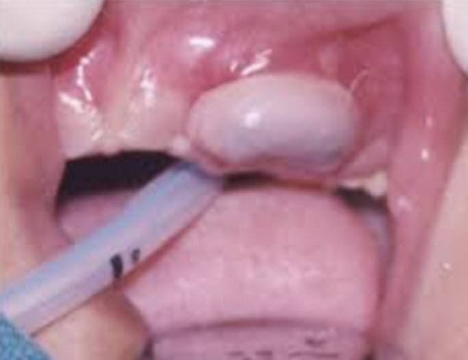 eruption cysts differential diagnosis melanotic of infancy cysts: A series two cases Oral Anomalies - Brisbane City