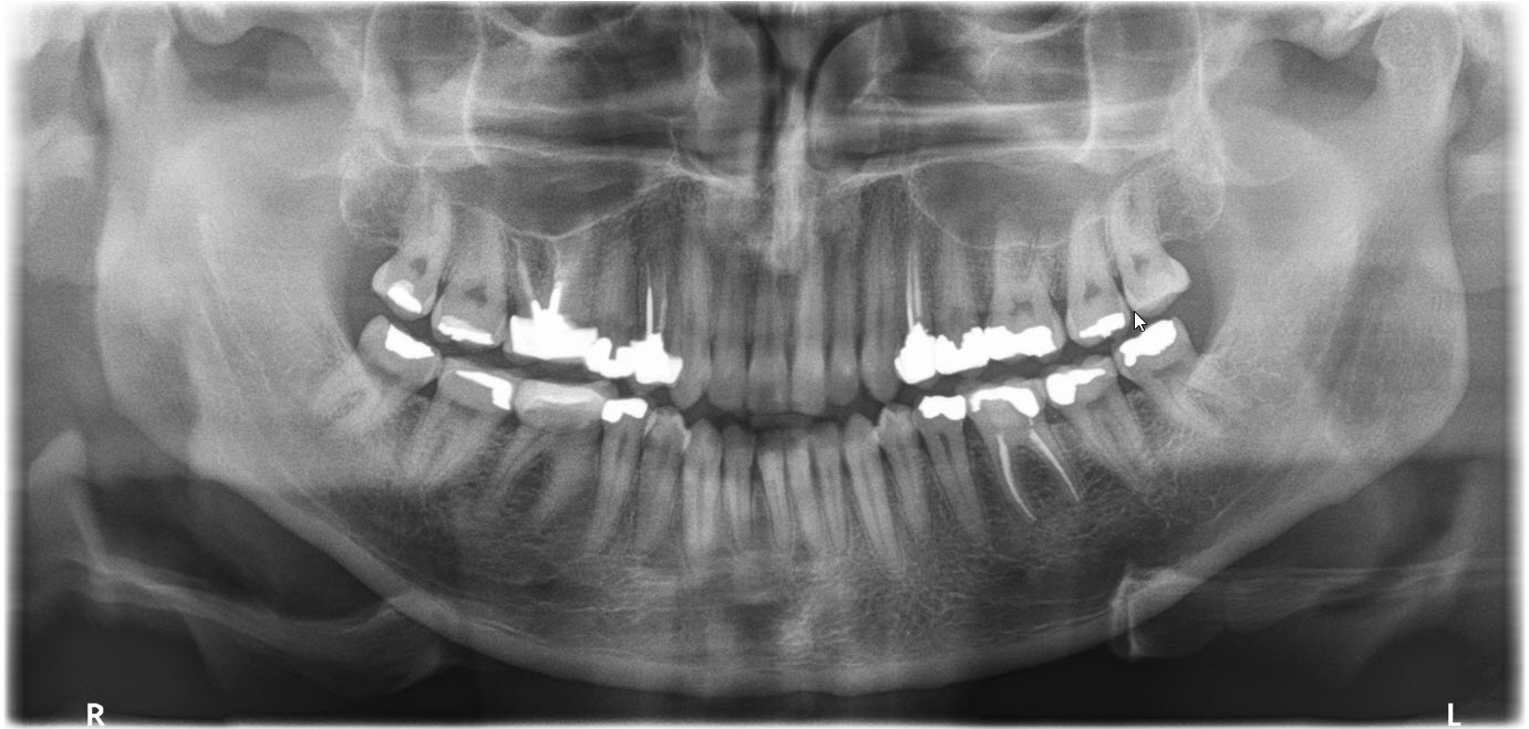 OPG X-ray view