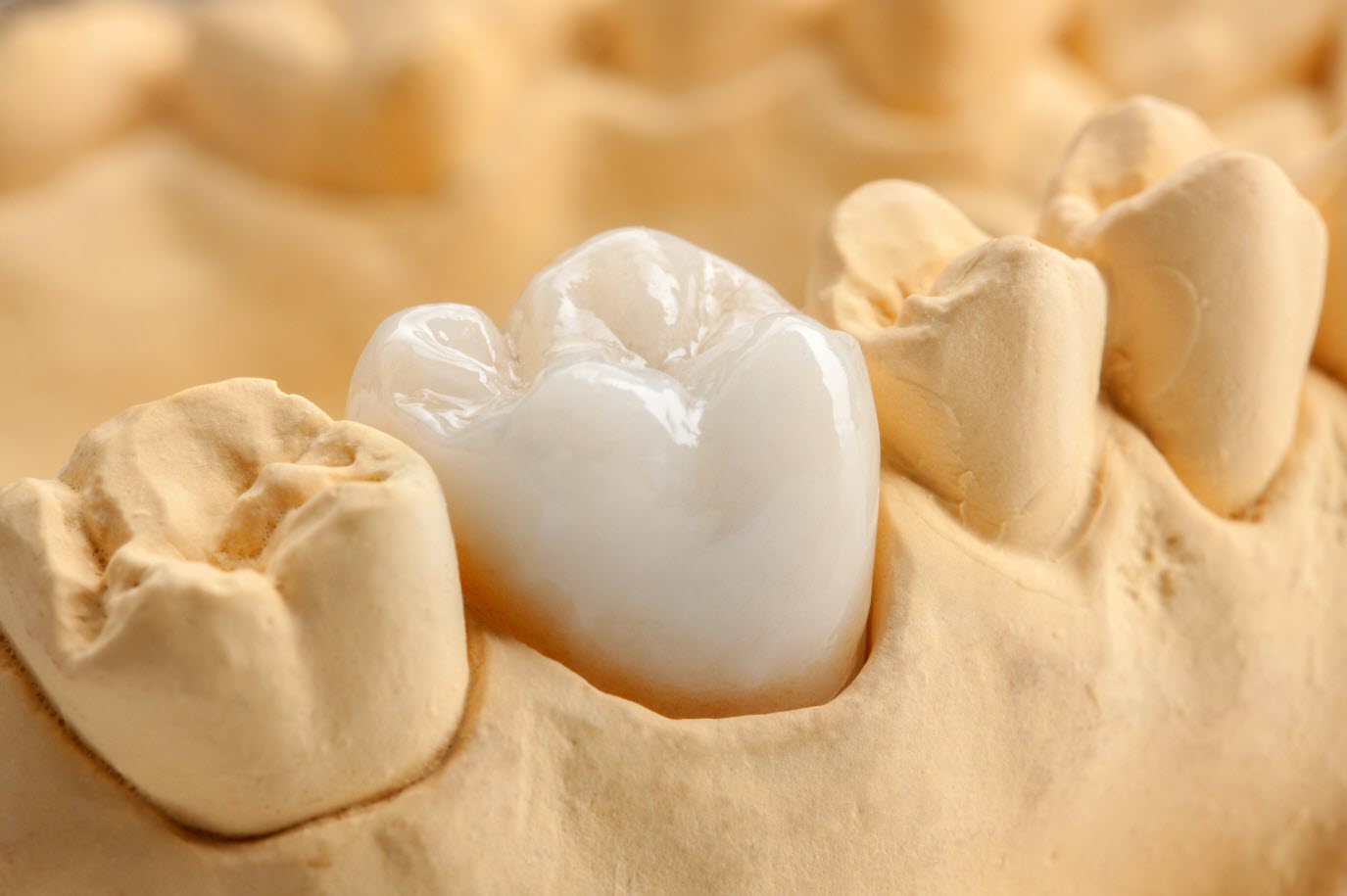 Zirconia Dental Restoration