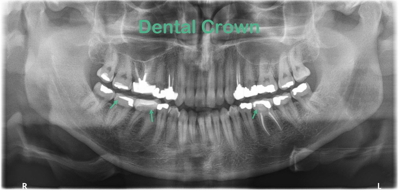 Xray of Dental Crown