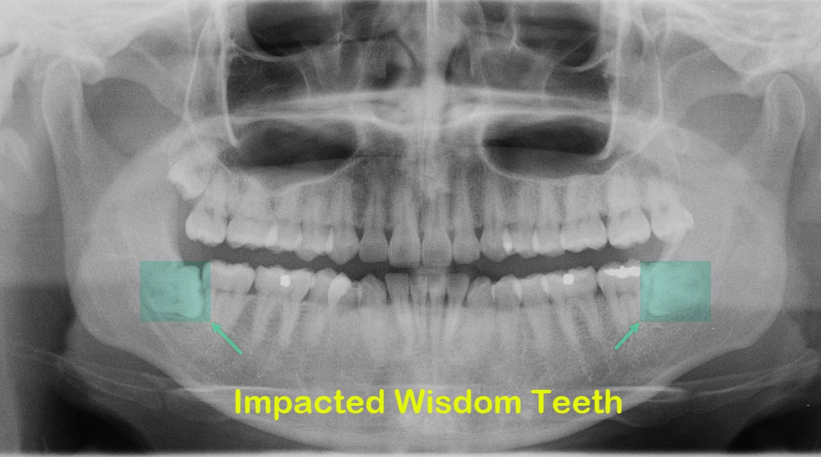 Brisbane Tooth Examination using OPG