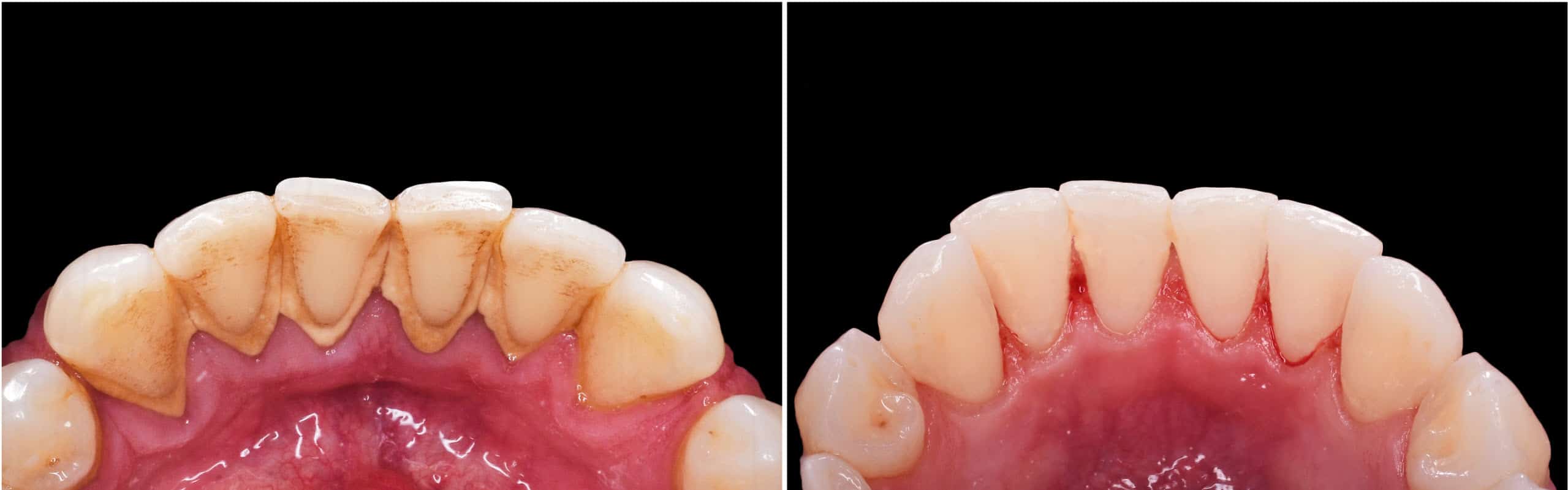 Without proper treatment & dental hygiene plan, the disease will worsen & develop