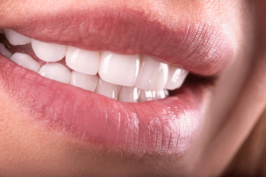 Perfect your smile with porcelain dental veneers