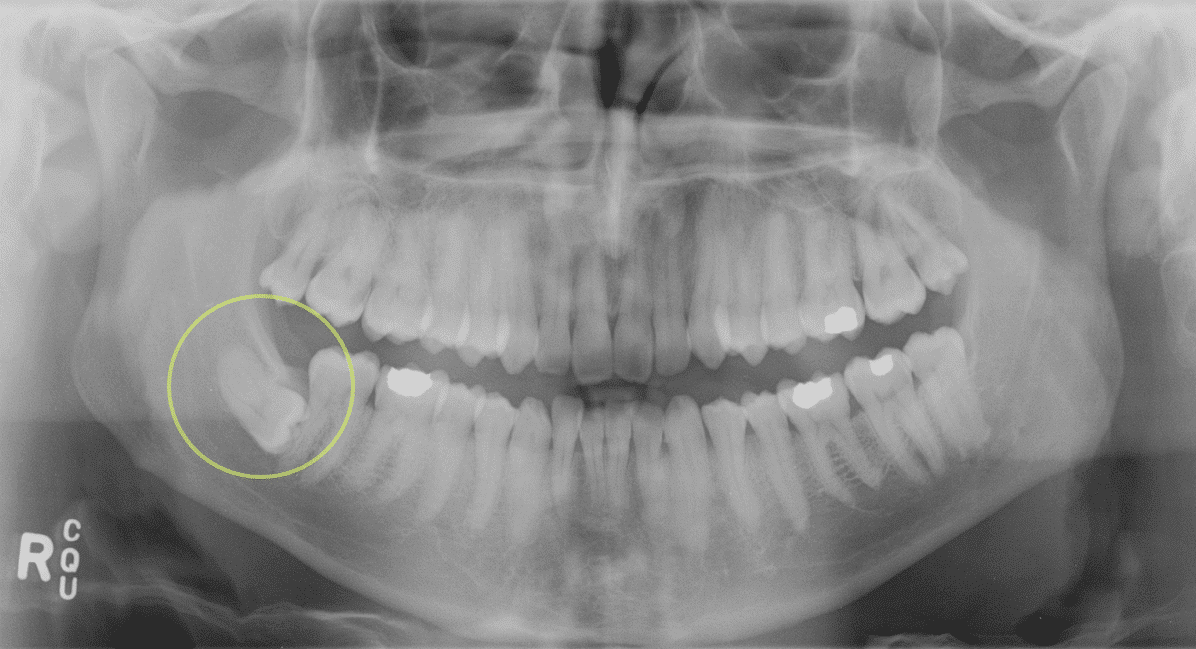 Dental extraction of third molars