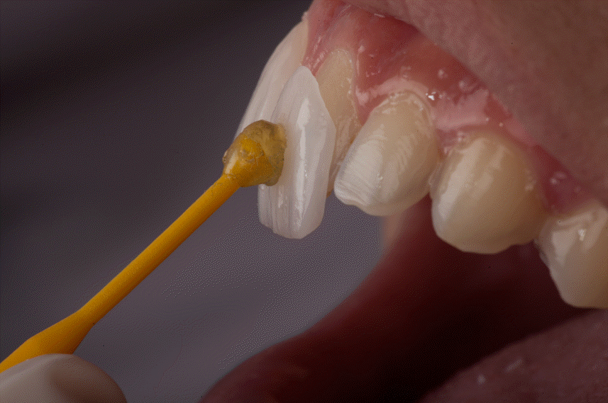 Get a natural-looking smile with porcelain veneer