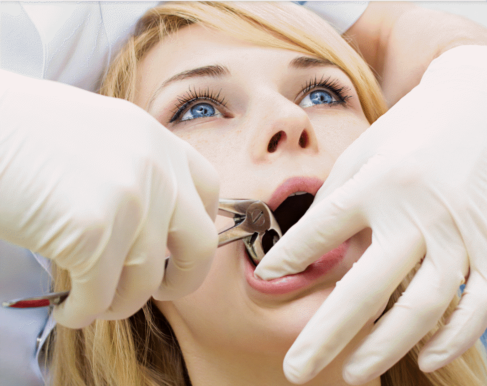 Wisdom Teeth Removal