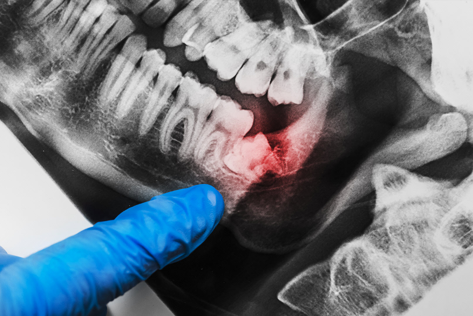 Severe toothache or discomfort in the back of your mouth