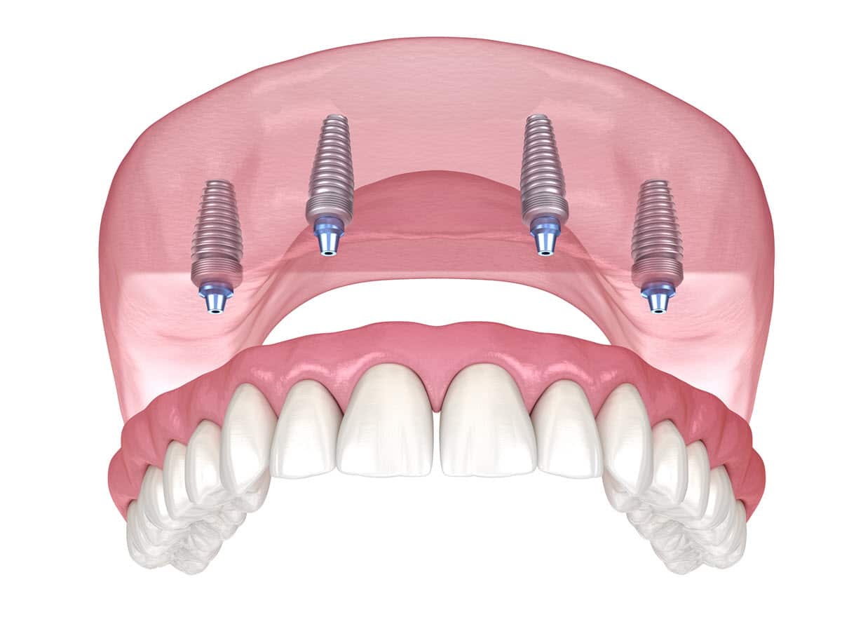 upper jaw with a dental prosthesis