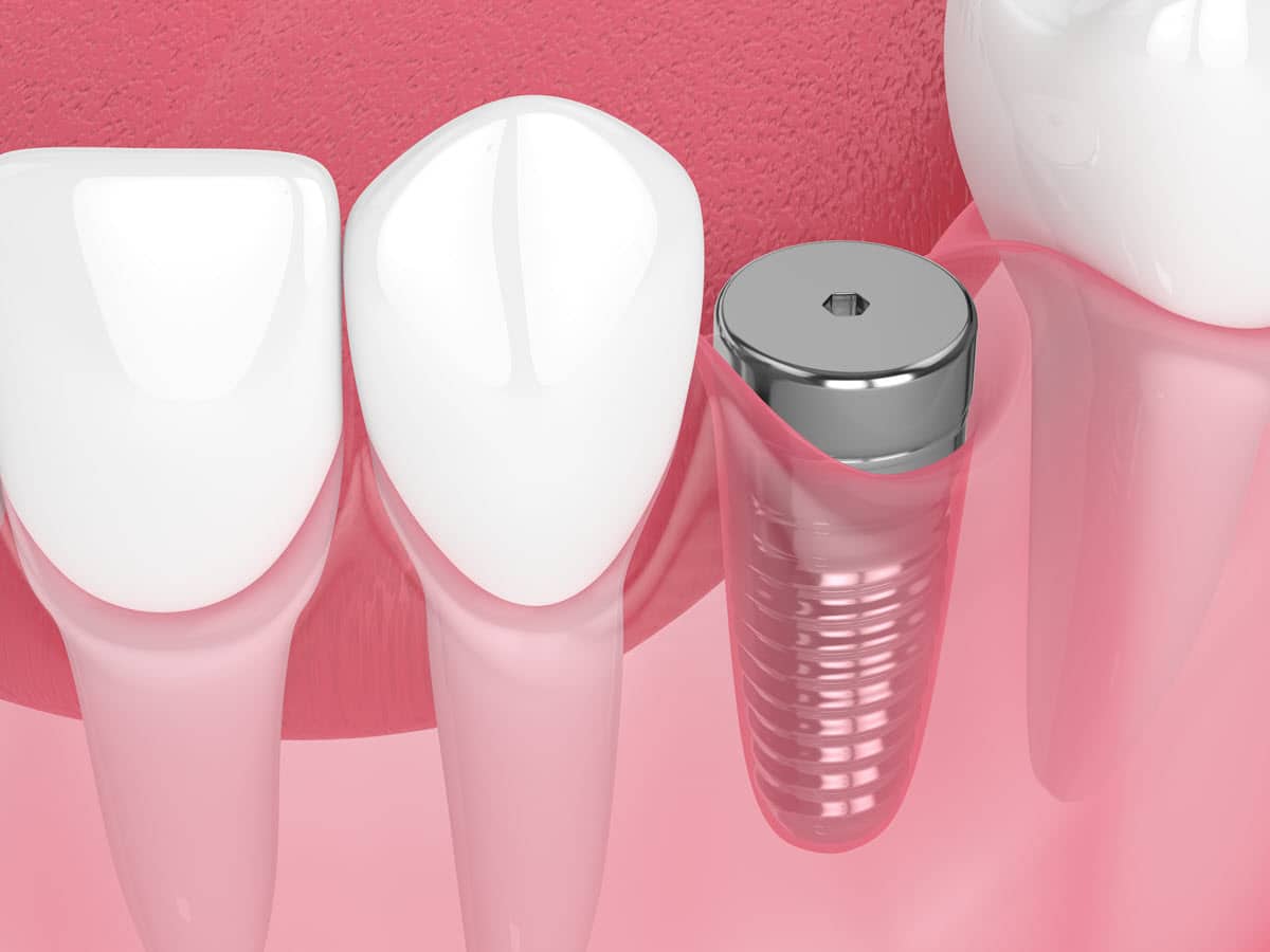 dental implant on the right is shown without its crown