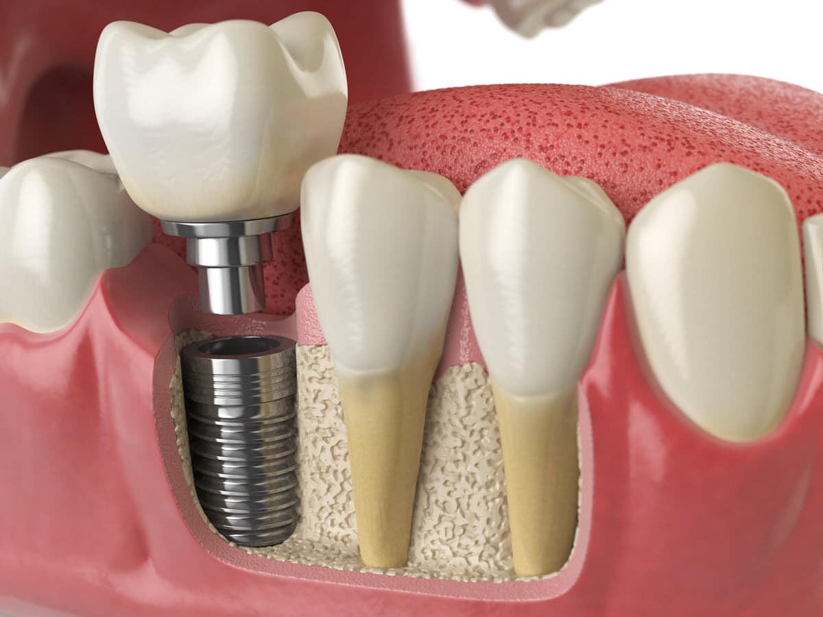 the implant, which is a metallic screw, embedded in the jawbone
