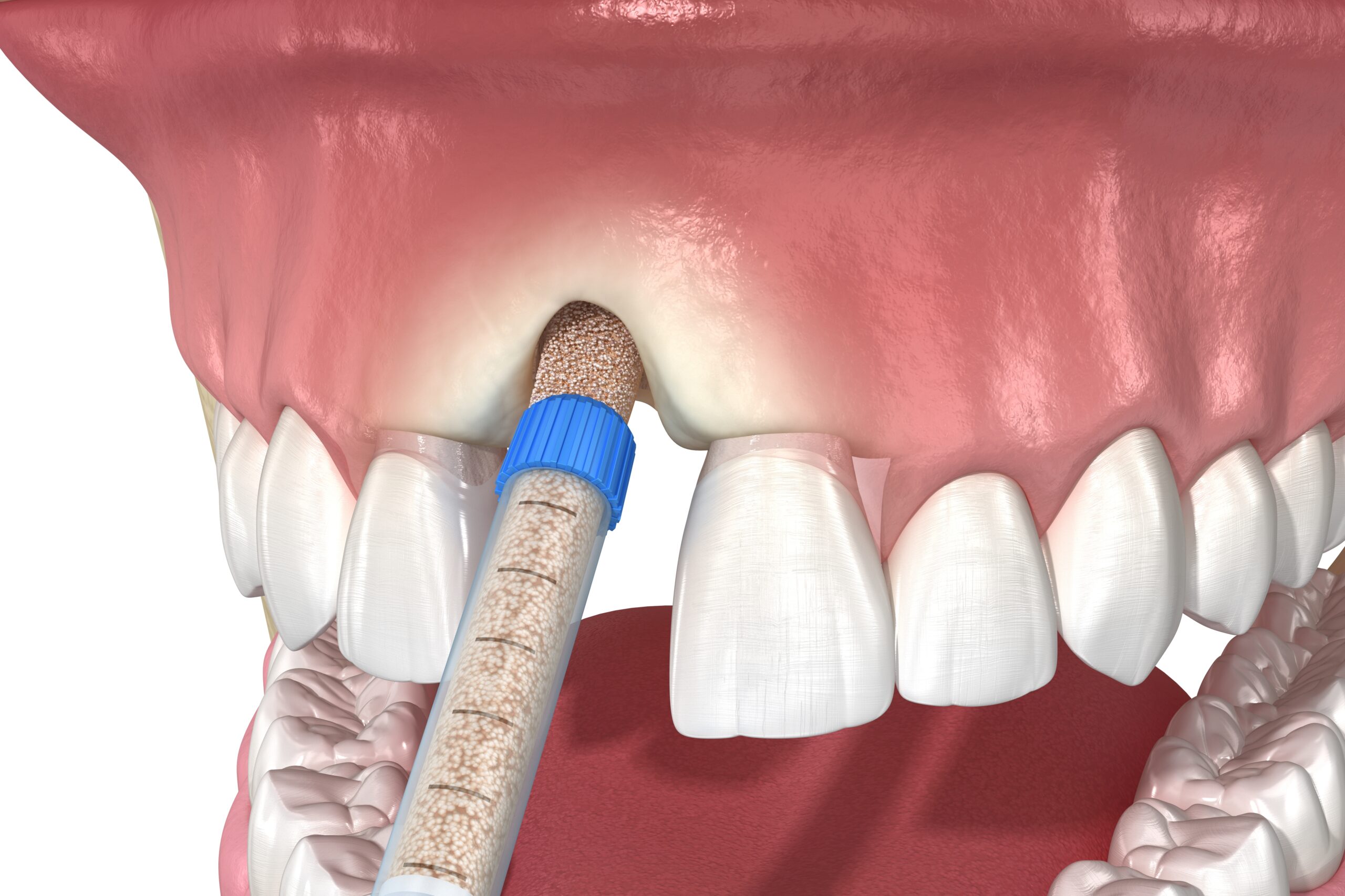 3D illustration of bone graft material being placed into an upper front tooth socket using an applicator syringe