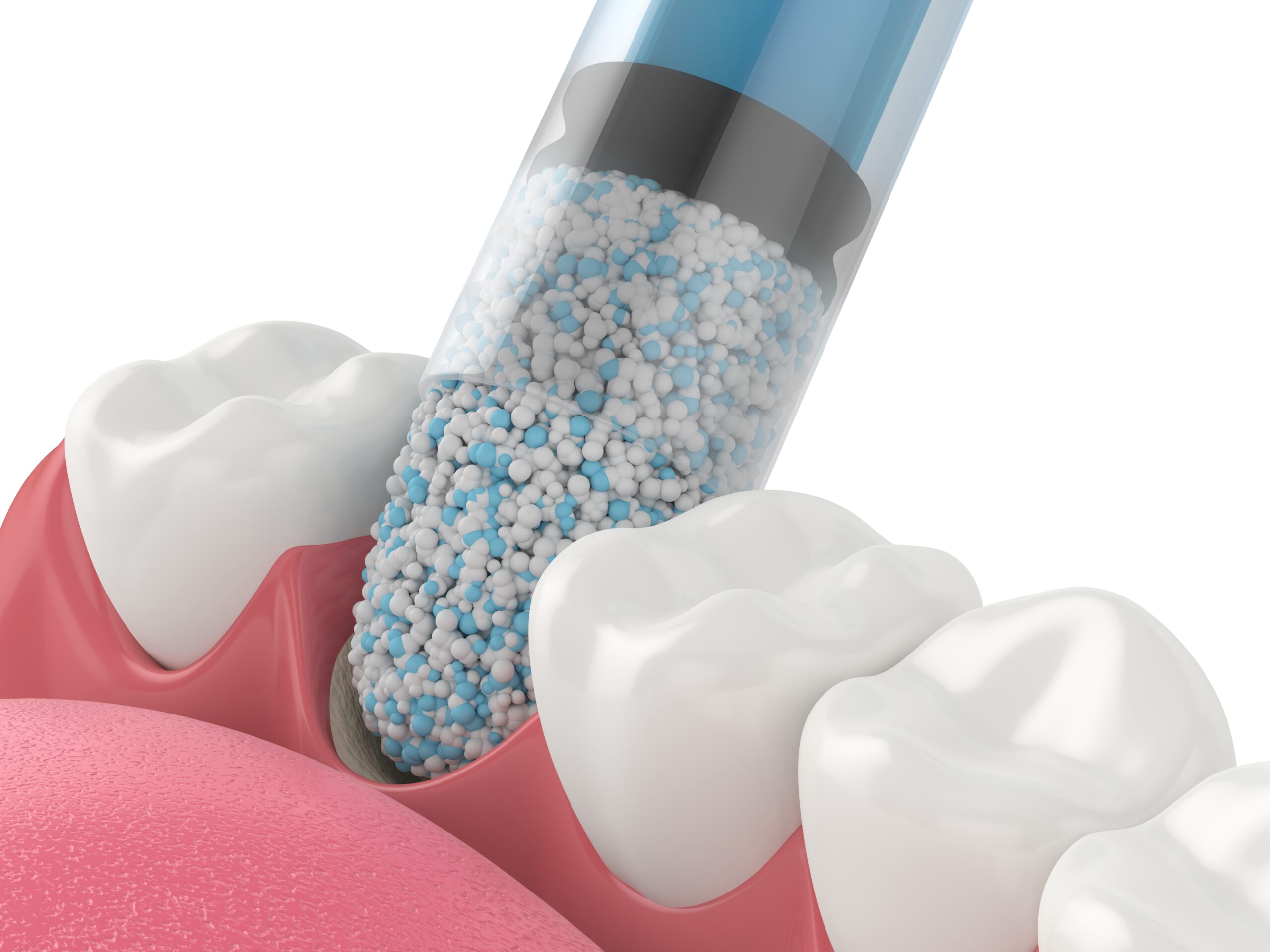 3D illustration of synthetic bone graft granules being applied to the jawbone between teeth with a syringe